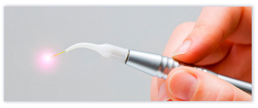 Процедура электрокоагуляции